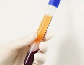 PRP – Plasma rico en plaquetas en Barcelona