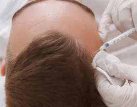 Alopecia androgenética en Barcelona