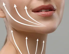  Microlifting facial en Barcelona