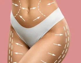 Liposucción corporal en Barcelona