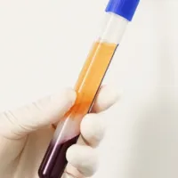 PRP – Plasma rico en plaquetas en Barcelona