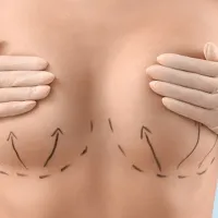 Mamoplastia de reducción en Barcelona
