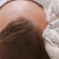 Alopecia androgenética en Barcelona