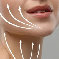 Microlifting facial en Barcelona