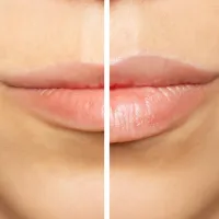Lip lift en Barcelona