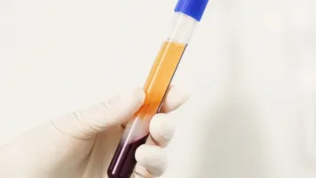 PRP – Plasma rico en plaquetas en Barcelona
