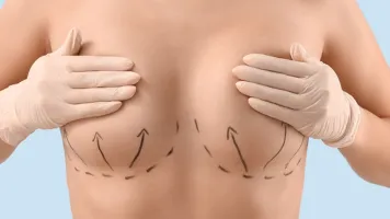 Mamoplastia de reducción en Barcelona