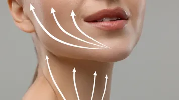 Microlifting facial en Barcelona