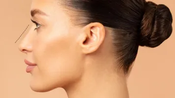 Rinoplastia en Barcelona