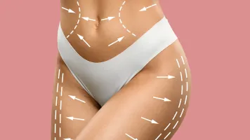 Liposucción corporal en Barcelona