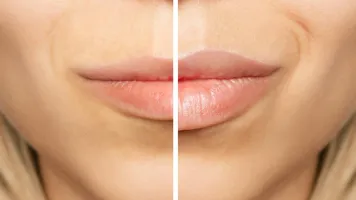 Lip lift en Barcelona