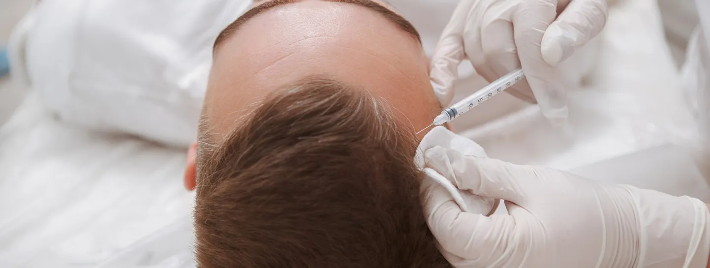 Alopecia androgenética en Barcelona
