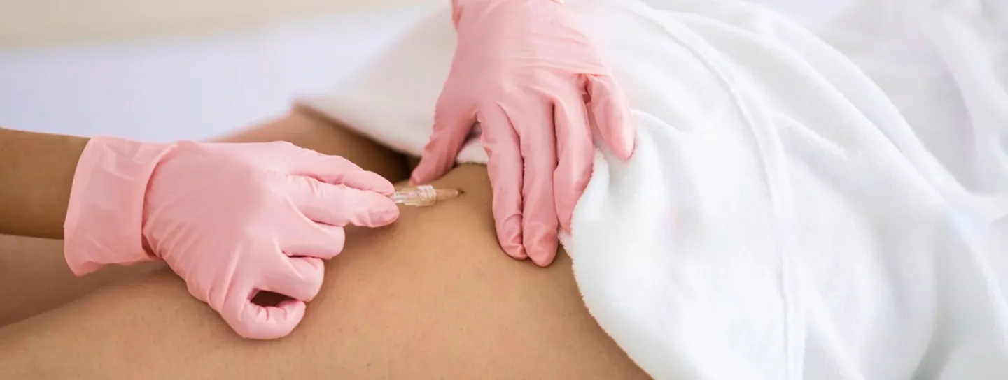 Carboxiterapia en Barcelona