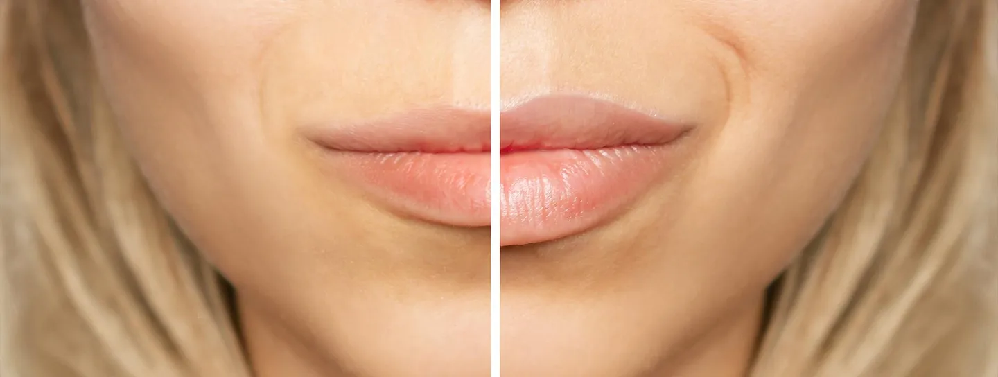 Lip lift en Barcelona