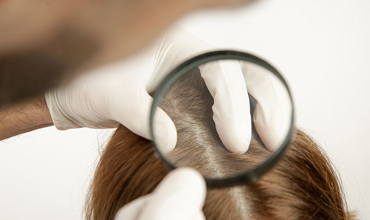 Medicina-endocrinología-alopecia